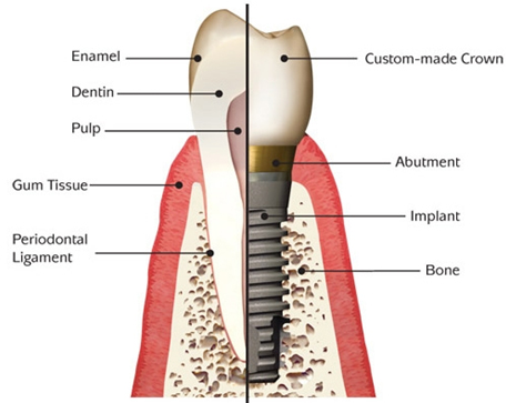 Perfect Smile tooth vs implant model